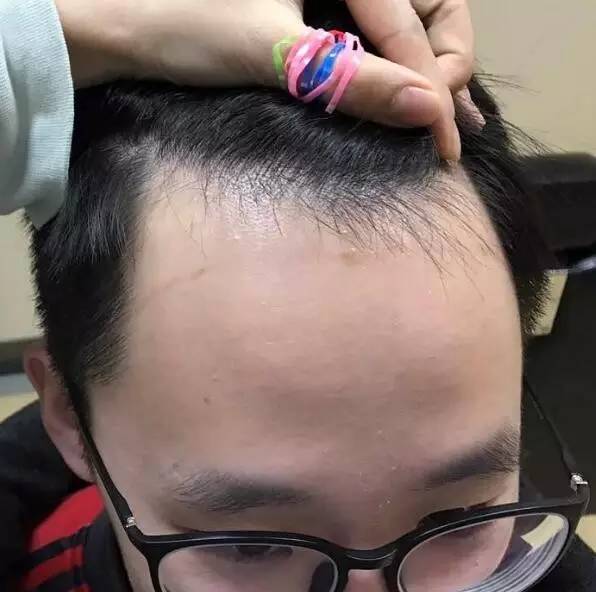 頭發(fā)變細軟是頭皮老化的重要表現