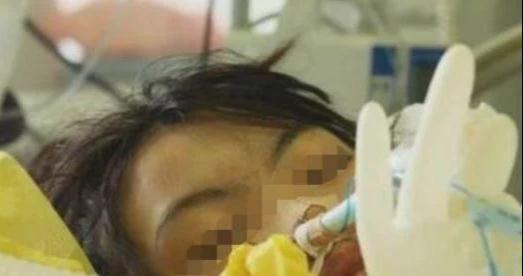 27歲女子遭前男友潑汽油燒傷致殘的故事