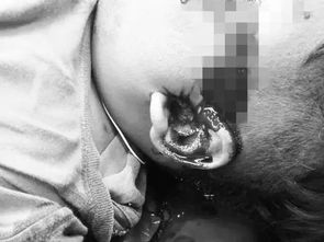 16歲男孩每天只睡5小時(shí)導(dǎo)致頭禿