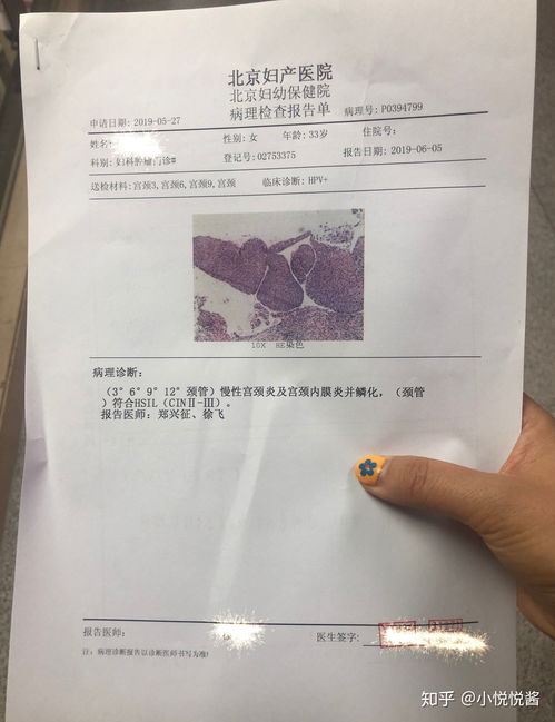 多數(shù)人感染HPV后兩年內(nèi)可自愈