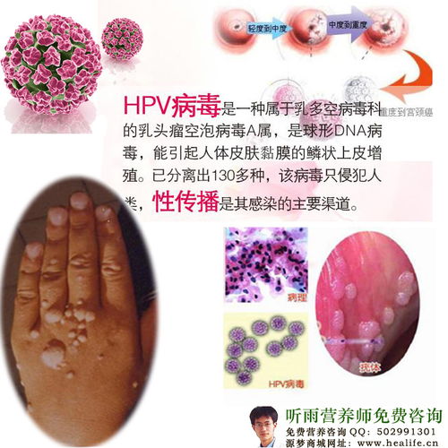 多數(shù)人感染HPV后兩年內(nèi)可自愈