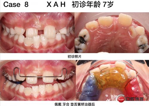 早期矯正游戲有哪些