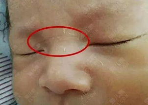 鼻梁青筋如何改善運勢（鼻梁筋青色的怎么了?）