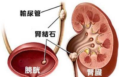 腎結(jié)石是什么星座,腎結(jié)石的人是什么星座