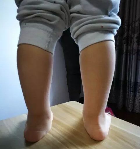 腳畸形運勢如何（腳畸形是什么原因造成的官網(wǎng)）